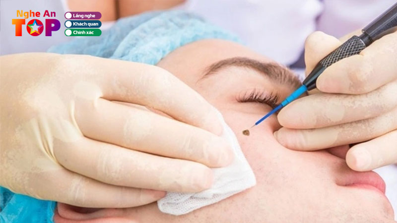 Top-10-dia-chi-xoa-not-ruoi-nghe-an-khong-dau-khong-seo-ngheantoplist