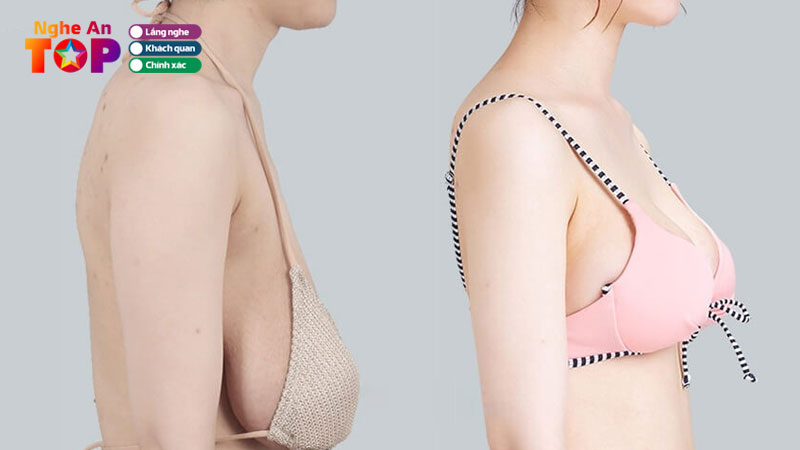 Top-5-dia-chi-phau-thuat-treo-nguc-sa-tre-tai-nghe-an-an-toan-ngheantoplist