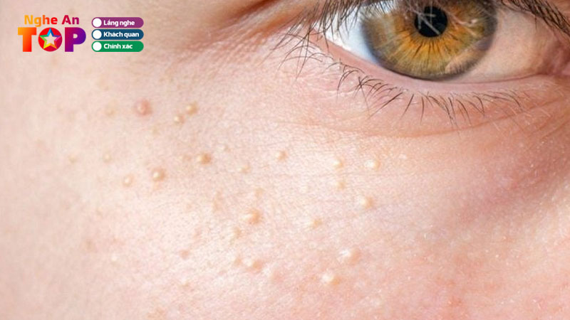 Top-5-dia-chi-xoa-mun-thit-tai-nghe-an-an-toan-tan-goc-ngheantoplist